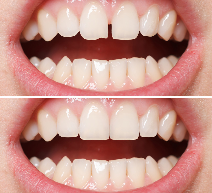 Veneers Ihr Zahnarzt in Rödermark Frank Bütow